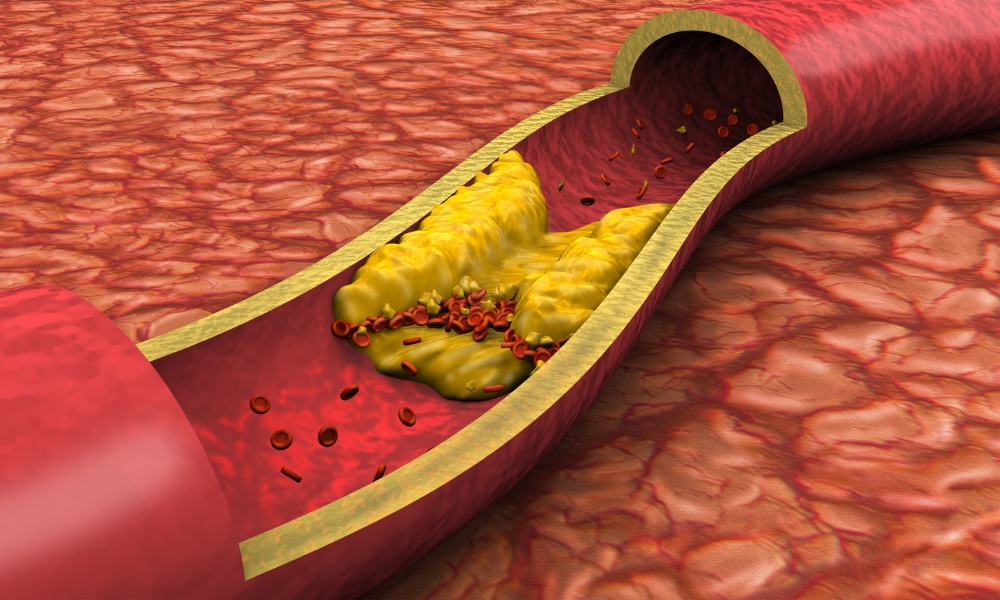 Kako najbrže smanjiti holesterol