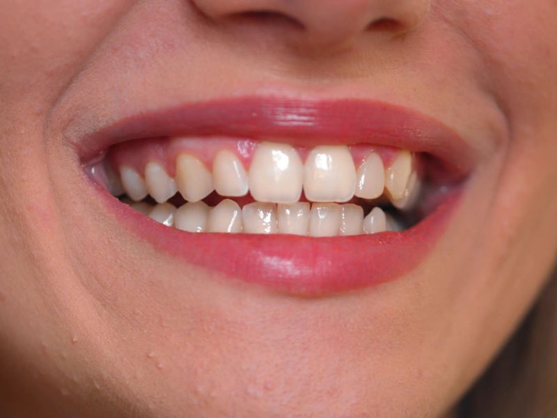 Saveti zubara za odrzavanje boje zuba bez agresivnih tretmana